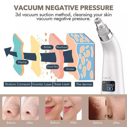 Blackhead Remover Vacuum Pore Cleaner USB Rechargeable